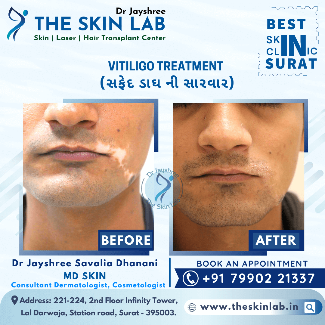 Best White Spot or Vitiligo Removal Treatment in Surat - The Skin Lab