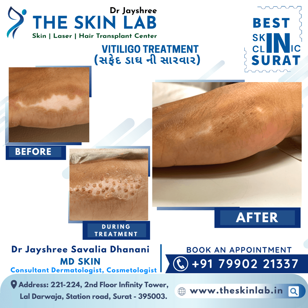 Best White Spot or Vitiligo Removal Treatment in Surat