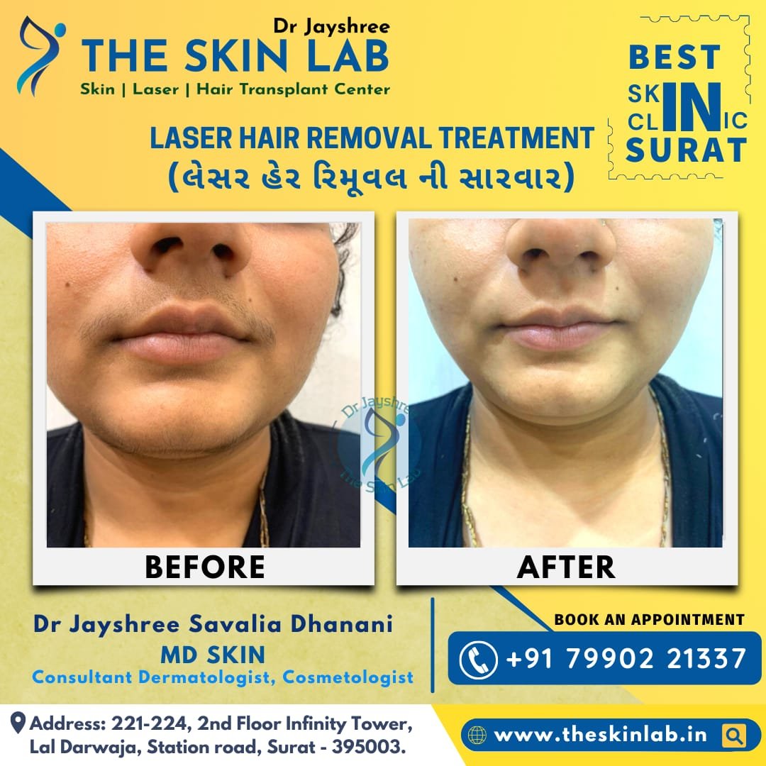 Top Laser Hair Removal Clinic in Surat with affordable Cost - The Skin Lab