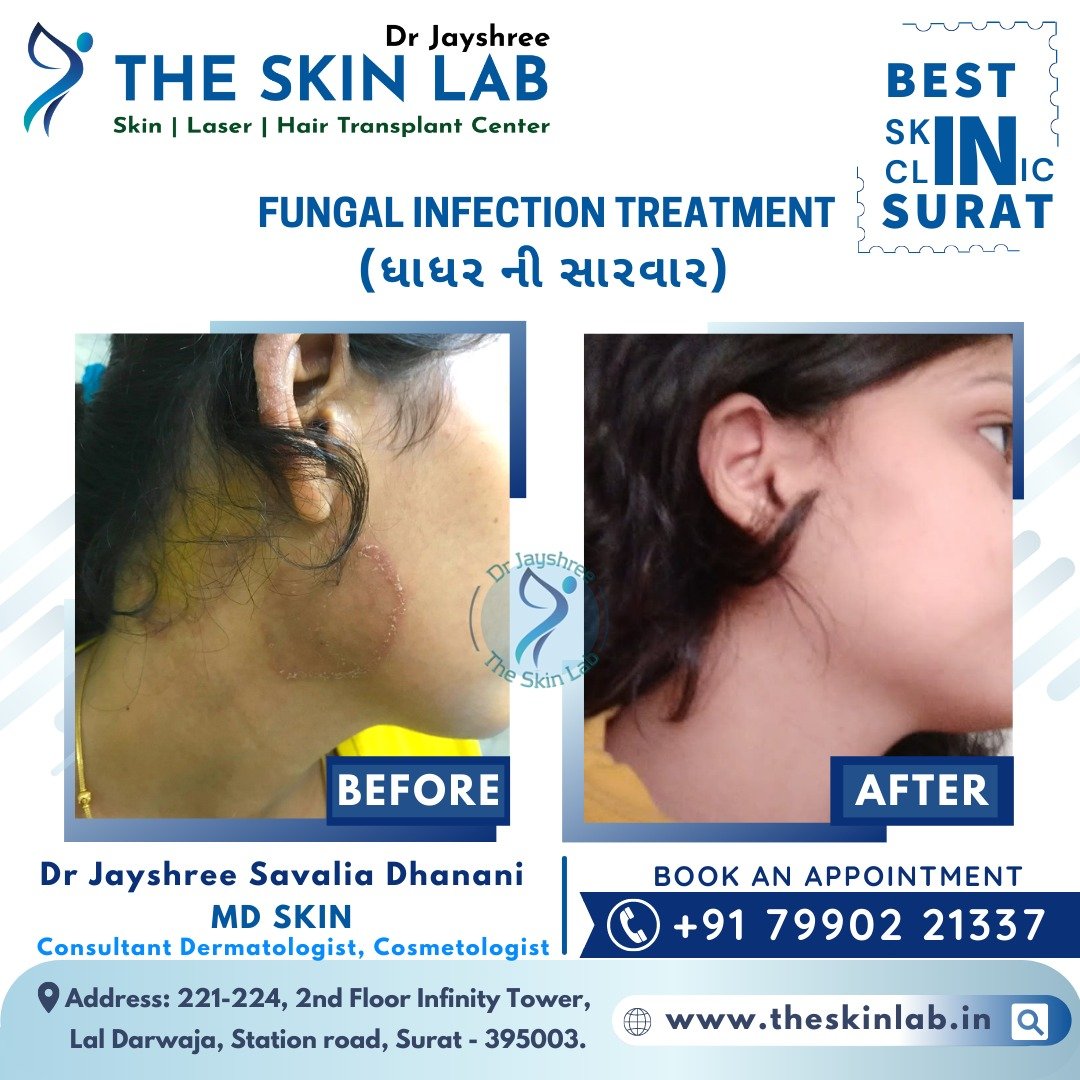 fungal-skin-infection-specialist-in-surat-dr-jayshree-savalia