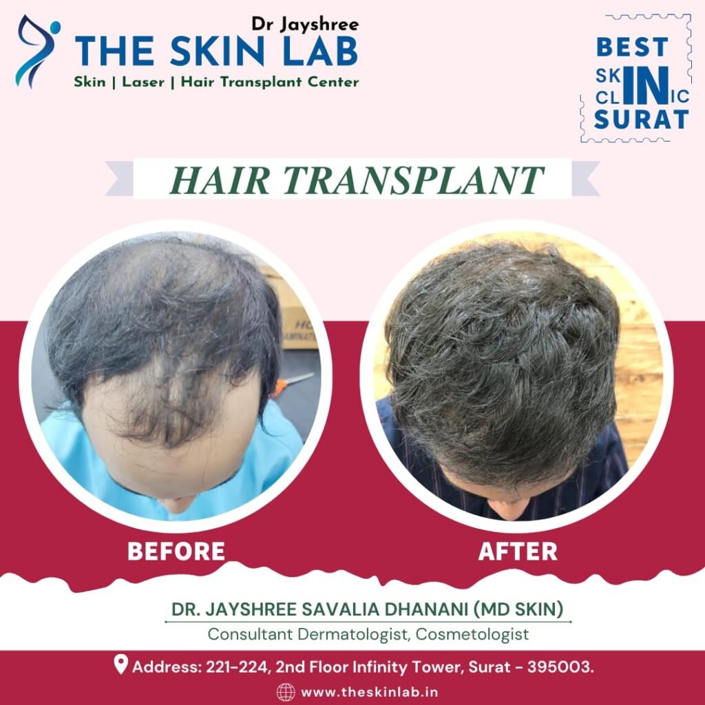 Hair Transplant Cost in Surat