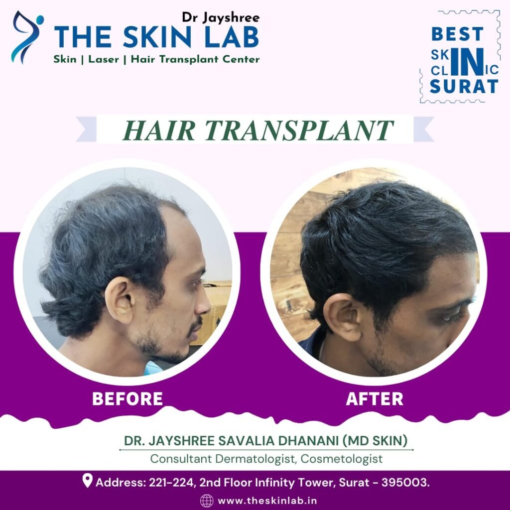 Best Hair Transplant Clinic Surat