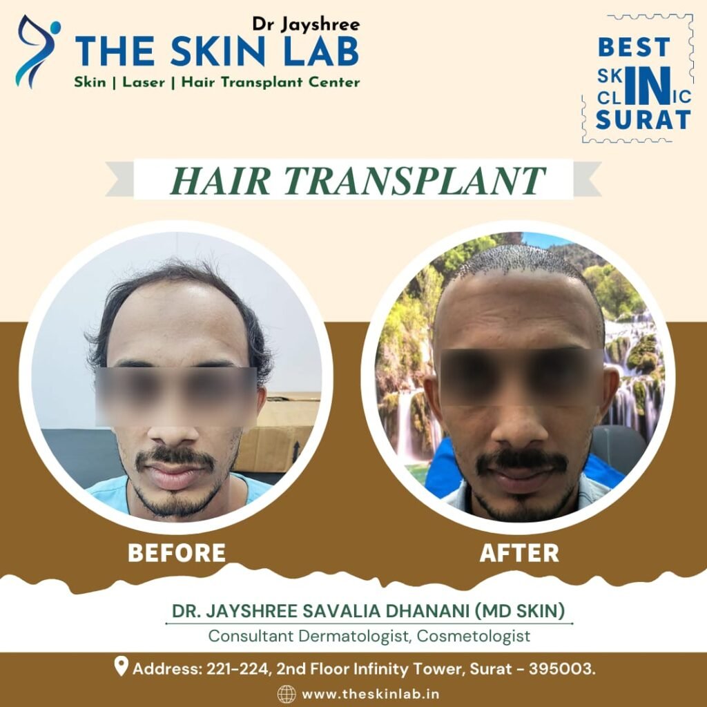 Hair Transplant Results Surat