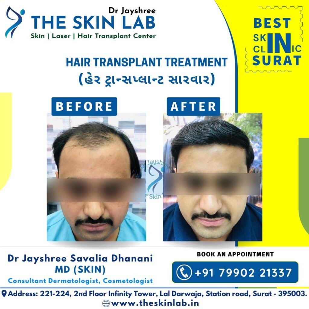 Hair Transplant Clinic Surat