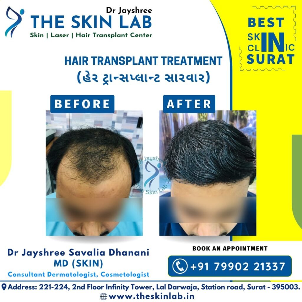 Hair Restoration Treatment in Surat