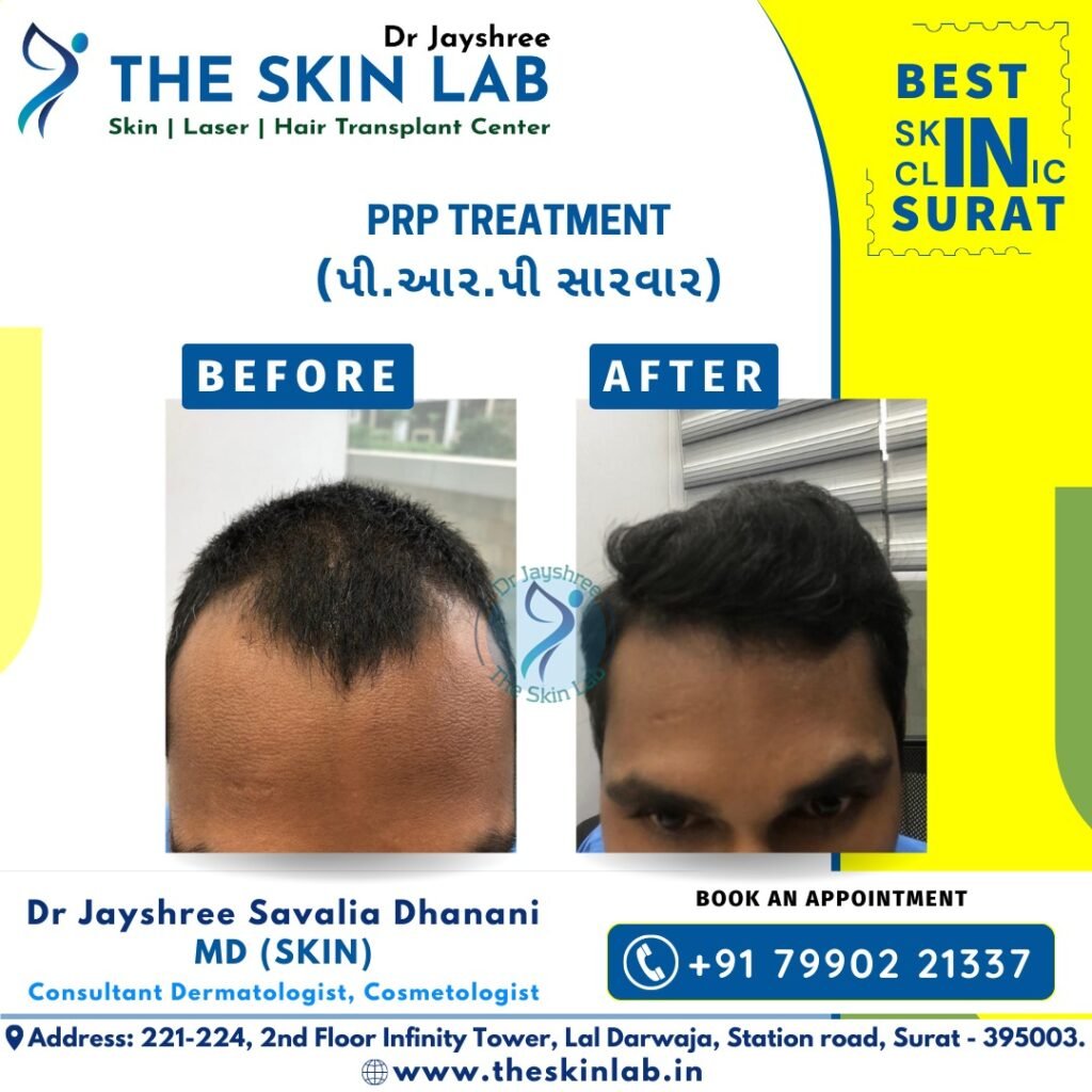 Hair Transplant Surat