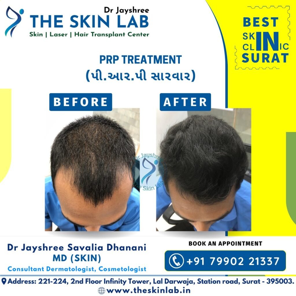 Hair Transplant in Katargam Surat