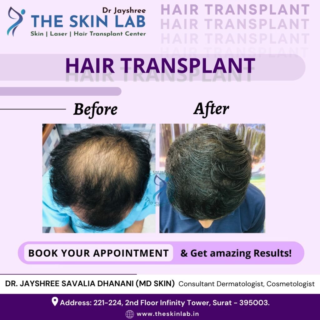 Best Hair Transplant in Adajan Surat