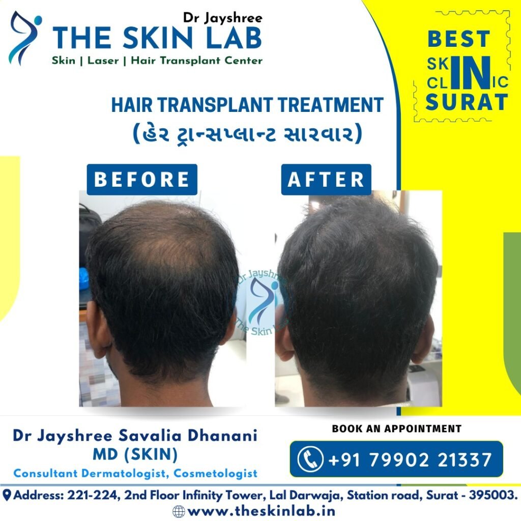 Hair Transplant in navasari 