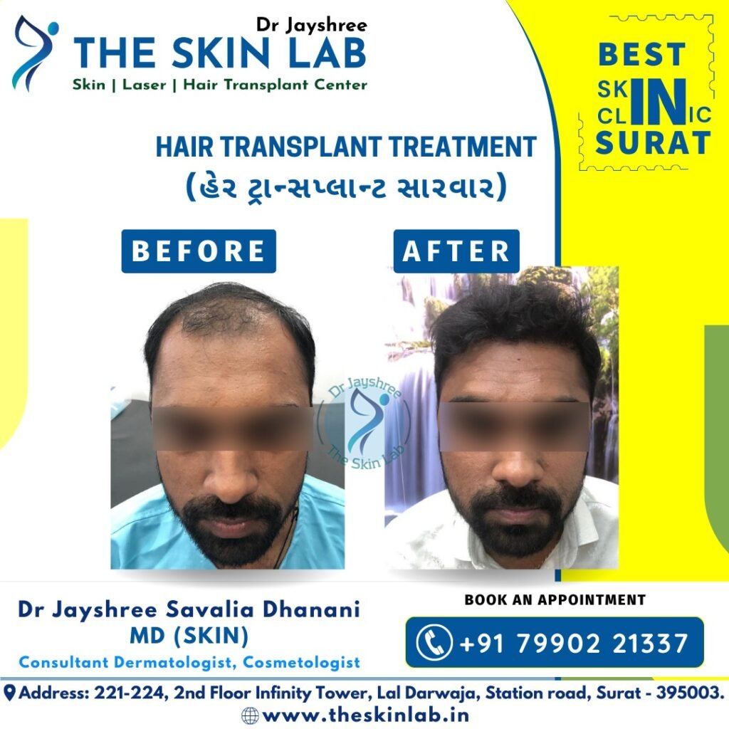 Best Hair Transplant in Vesu Surat