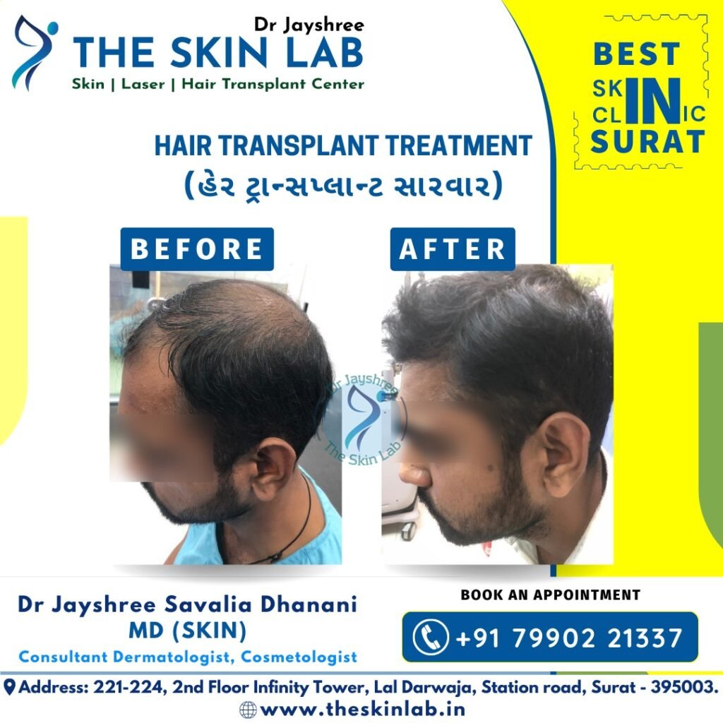 Hair Transplant in Bardoli