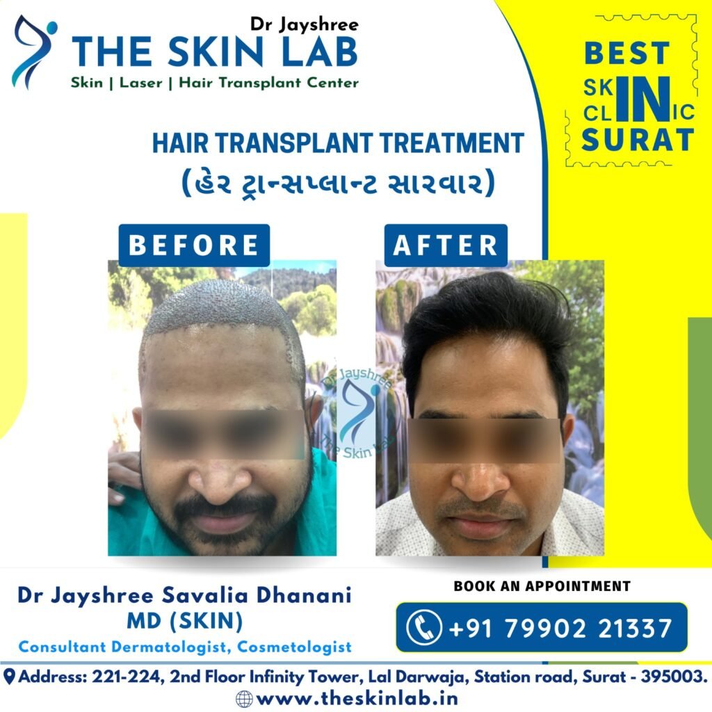 Hair Transplant