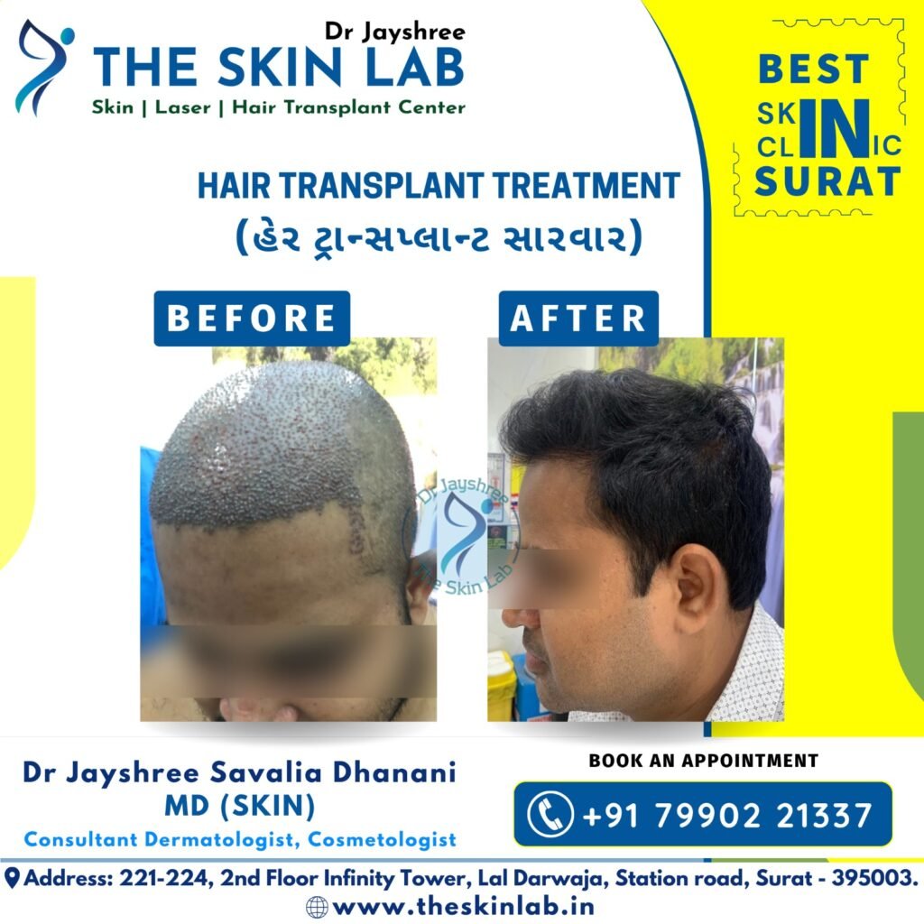 Hair Transplant in Surat