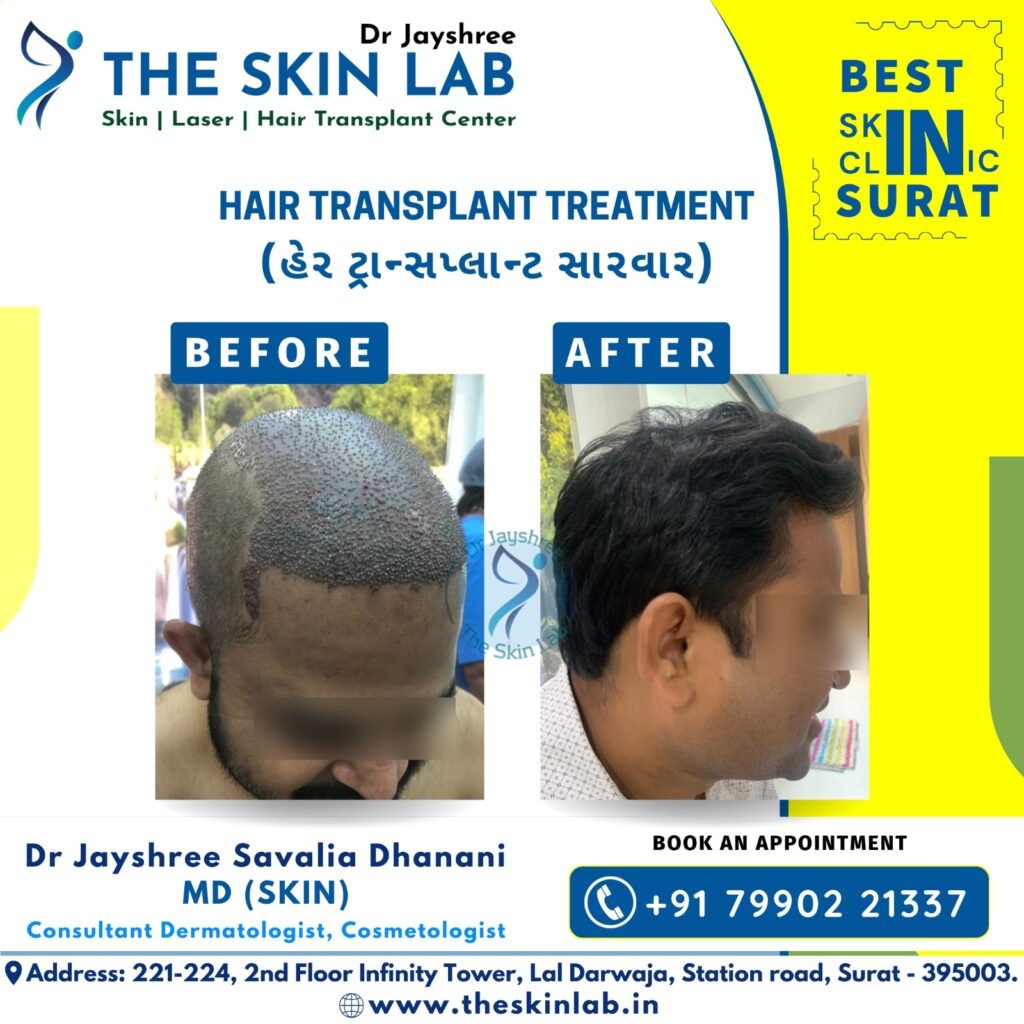 Hair Transplant in Surat